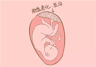 孕晚期胎盤老化能順產嗎 胎盤三級必須剖腹產嗎