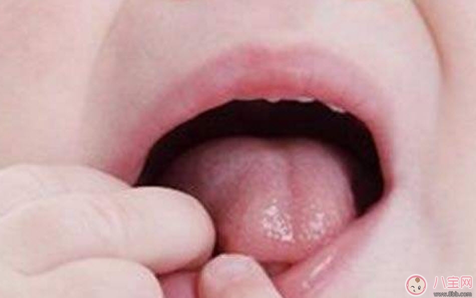 寶寶口腔潰瘍原因有哪些 寶寶口腔潰瘍怎么辦吃什么好的快