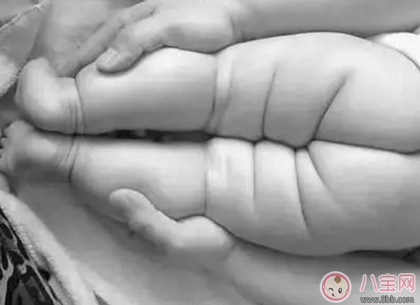 寶寶臀紋不對稱怎么回事 臀紋不對稱一定是髖關節發育不良嗎