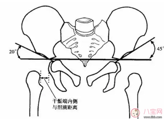 寶寶臀紋不對稱怎么回事 臀紋不對稱一定是髖關節發育不良嗎