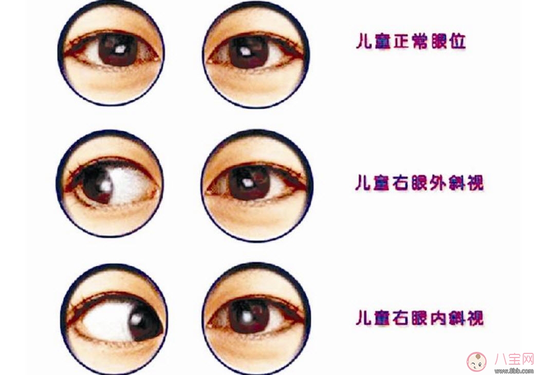 寶寶斜視手術風險大嗎 寶寶斜視一定要做手術嗎
