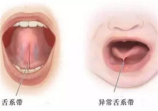 寶寶舌系帶過短怎么辦 舌系帶過短一定要做手術嗎
