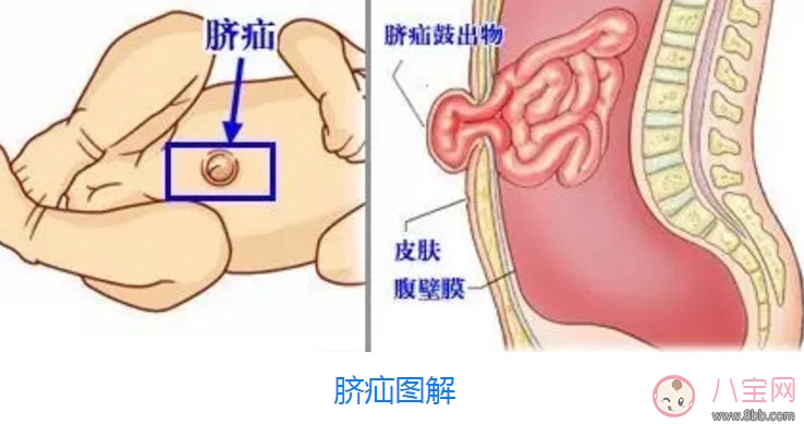 臍疝對寶寶有什么影響 寶寶臍疝是什么原因引起的