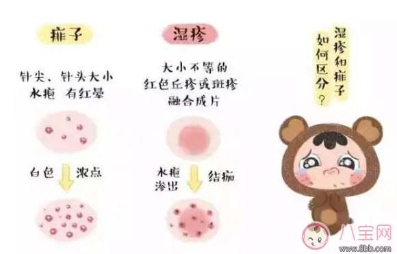 寶寶痱子和濕疹的區別 濕疹和痱子的區別圖片