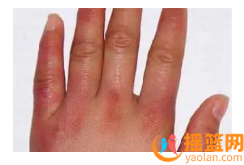 【夏季防曬】狼瘡患者必備！有效預防系統性紅斑狼瘡|35+保暖措施