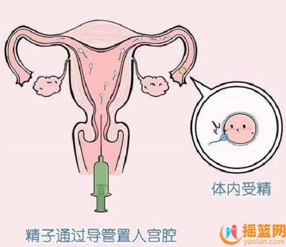 人工授精不能決定生男生女