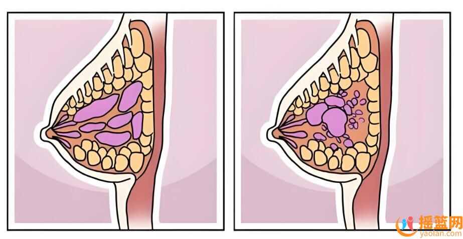 面對乳腺增生和結節，這一誤區千萬別踏入！