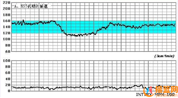 孕期胎心監測與宮縮觀察指南：步驟、指標與注意事項